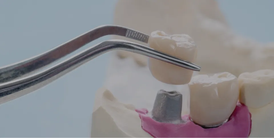 Dental Crowns at Divine Dental Centre in Las Vegas, New Mexico