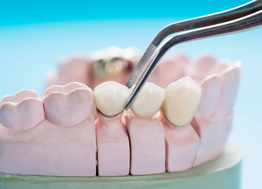 Dental Crowns at [pracitice_name] in Las Vegas, NM