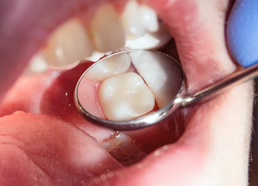 Dental Fillings at [pracitice_name] in Las Vegas, NM