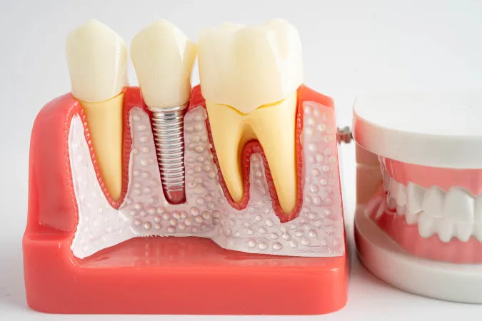 Dental Implants at [pracitice_name] in Las Vegas, NM